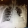An X Ray of my chest in Hawaii where they put in the first pacemaker/defibrillator